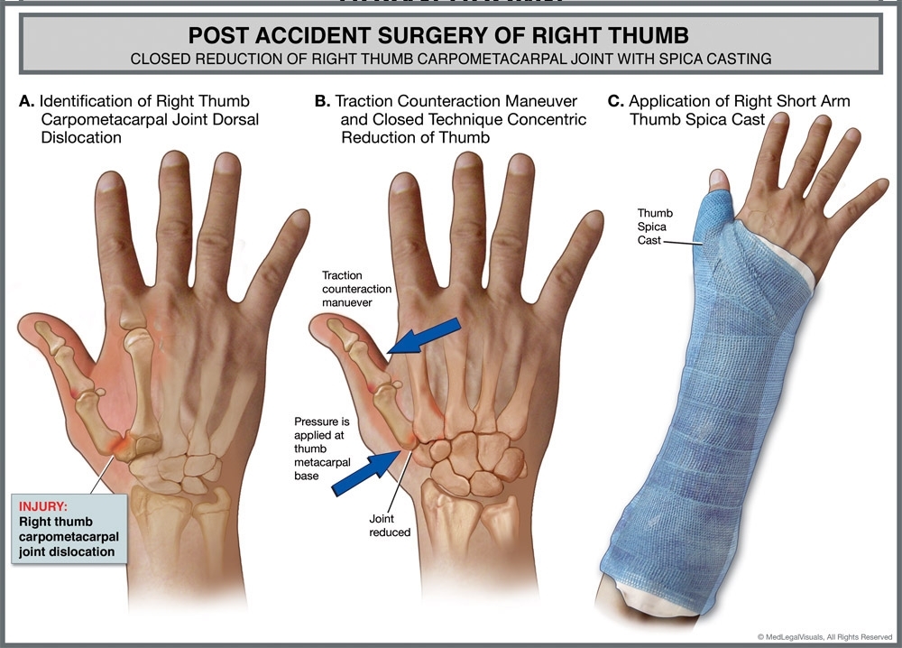 closed-reduction-dislocation-it-cast-how-to-apply