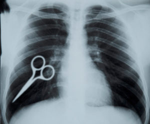 xray of chest with medical scissors inside