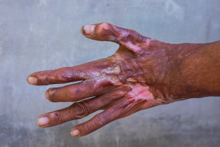 Messed up hand