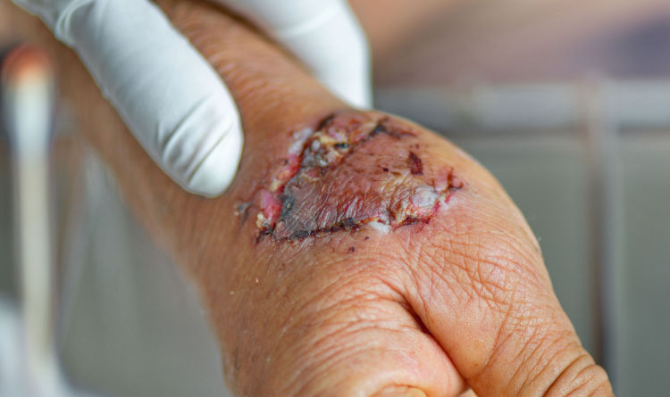 Dog bite on hand